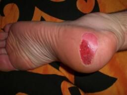 Comment éviter les ampoules lors de randonnées au long cours Article : Comment éviter les ampoules lors de randonnées au long cours